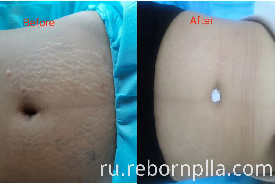 stretch marks removal